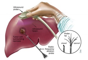 Tumor Ablation