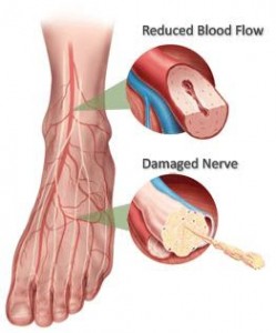 diabetic-neuropathy