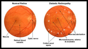 diabetic-retinopathy