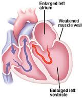 ischemic cardiomyopathy