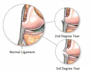 ligament_injury