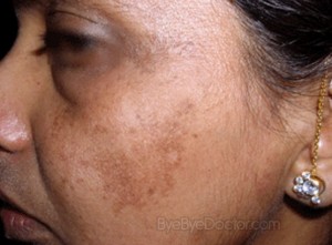 melasma