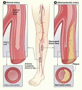 pad_plaque