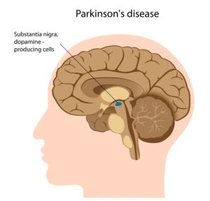 parkinson's disease copy