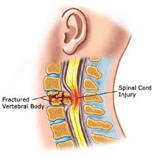 spinal cord injury