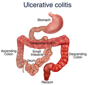 ulcerative-colitis