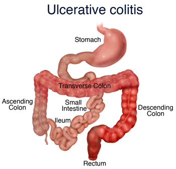 Ulcerative Colitis - stemcellreferencestemcellreference