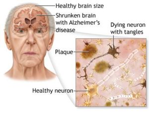 Alzheimers-Disease