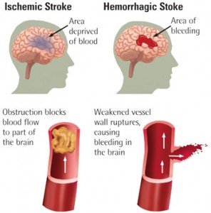 different_types_of_strokes