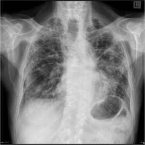 pulmonary fibrosis