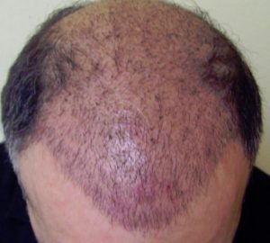 redness-after-hair-transplant