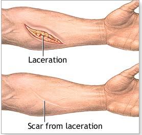 scar-tissue-from-surgery