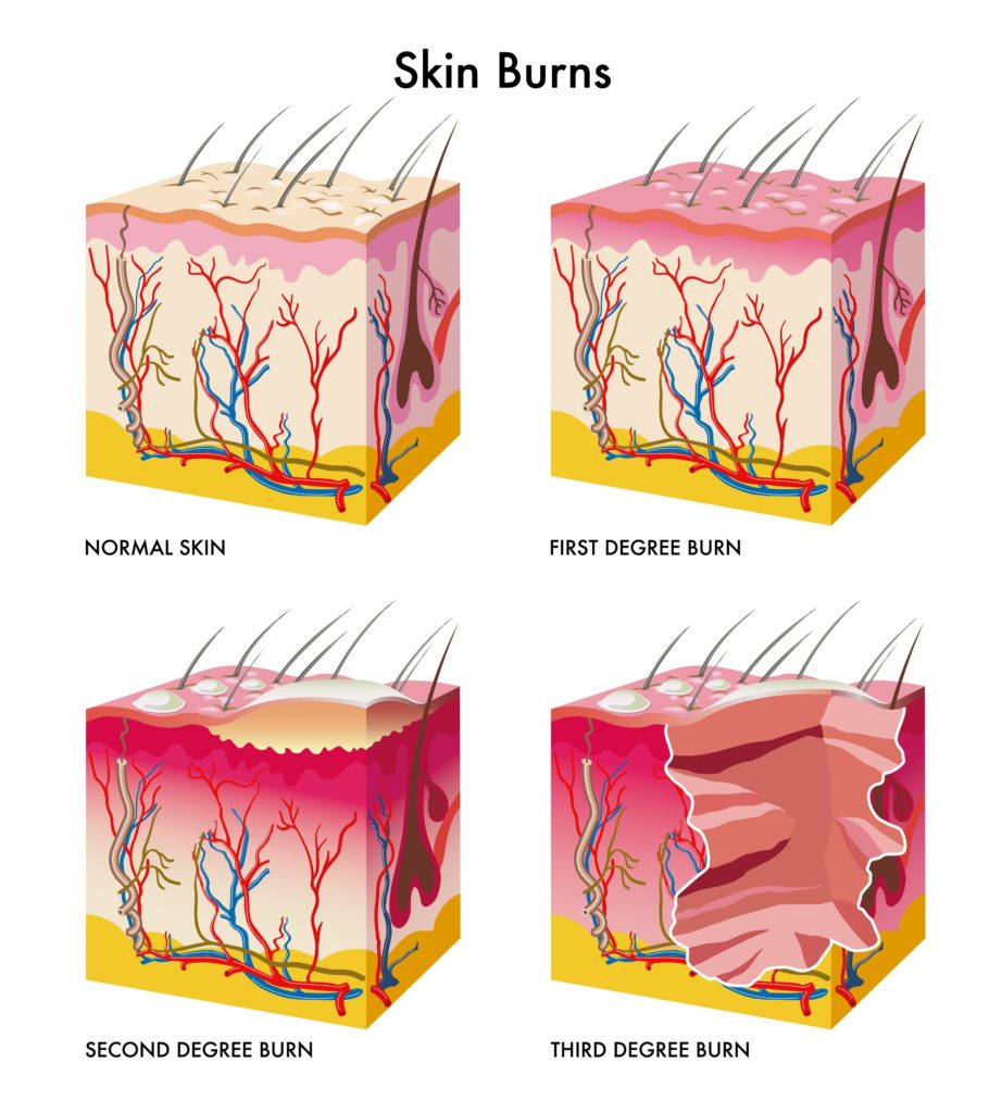 Burn Scars stemcellreference