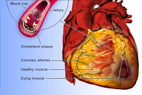 cardiomyopathy ischemic