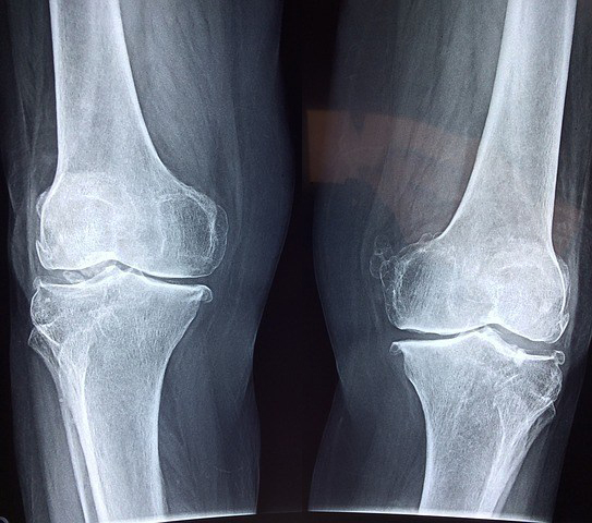 A Stem Cell Treatment For Knee Osteoarthritis (Medical News Bulletin ...